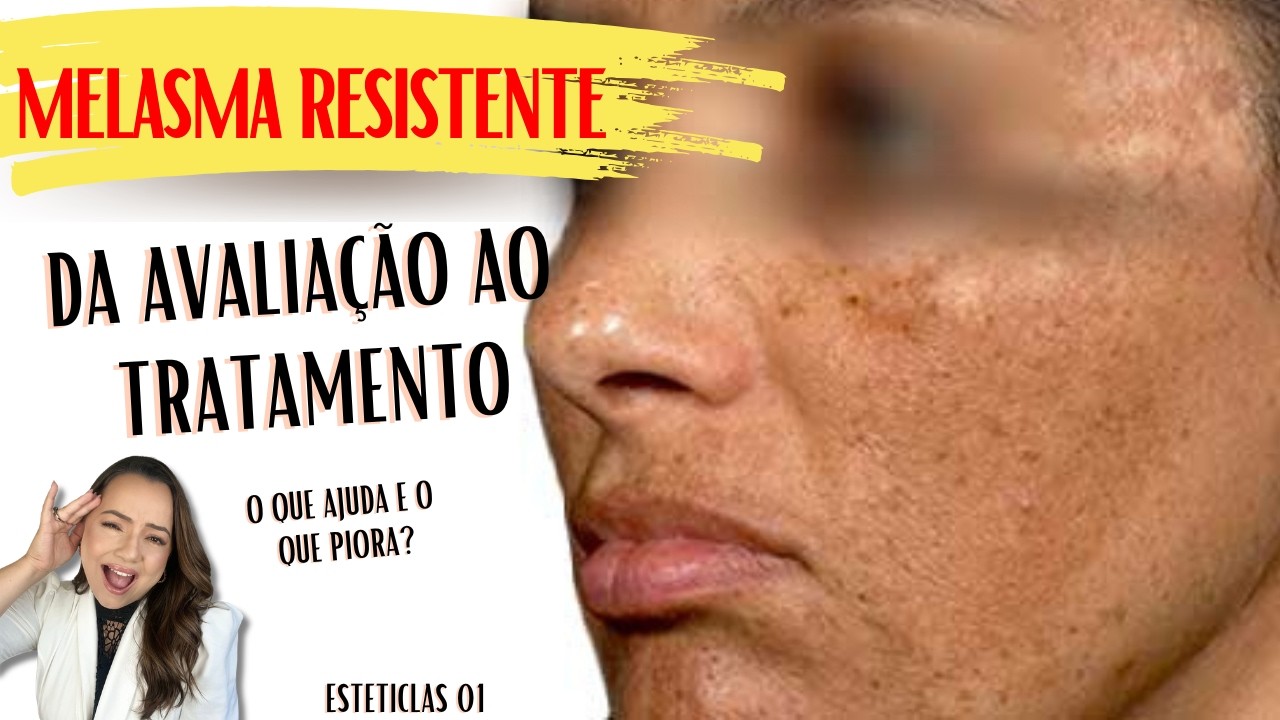 COMO AVALIAR E TRATAR O MELASMA RESISTENTE? #Esteticlass01