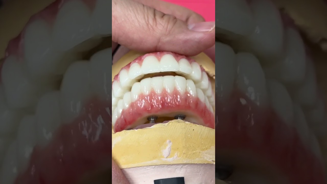 Full Mouth PMMA Provisionals