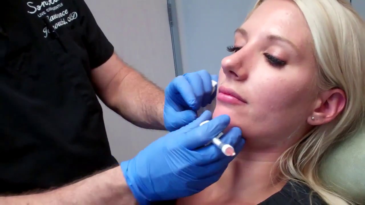 Filler to Define the Jawline and Correct a Recessed Jawline