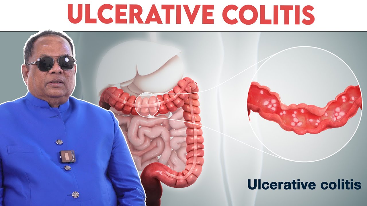 Ulcerative colitis / CKN