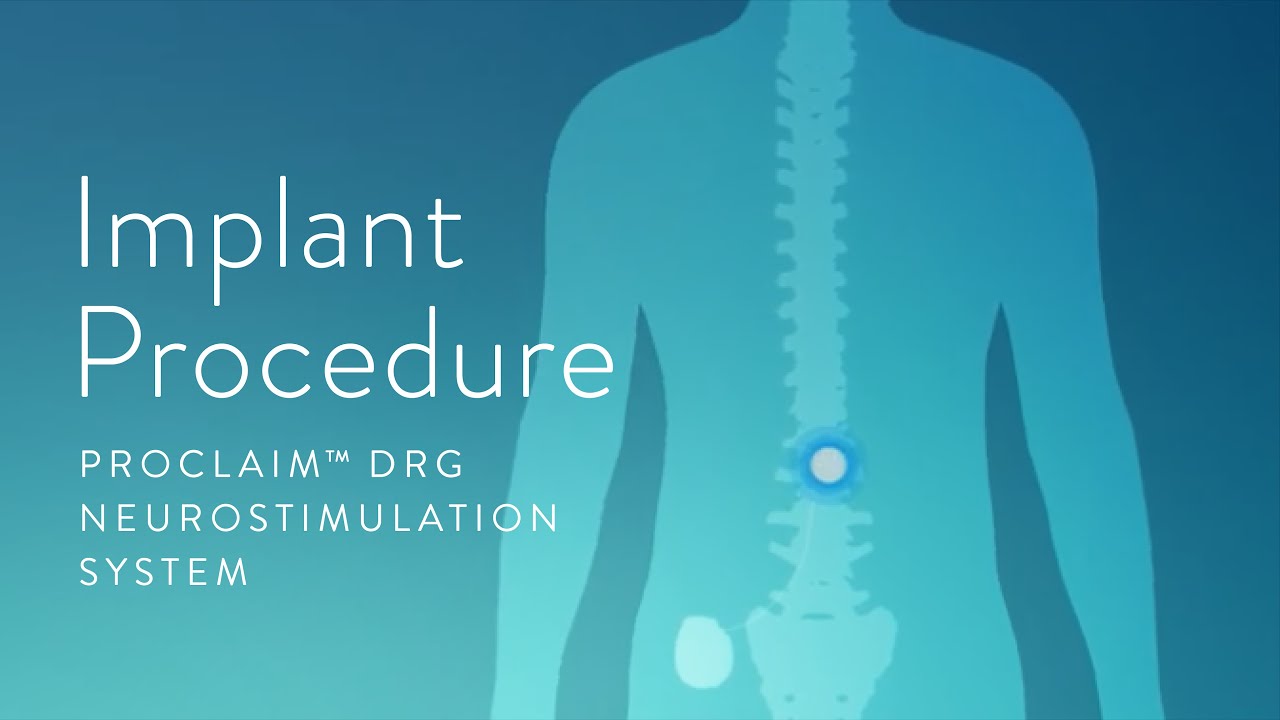 What to expect for the Dorsal Root Ganglion (DRG) procedure