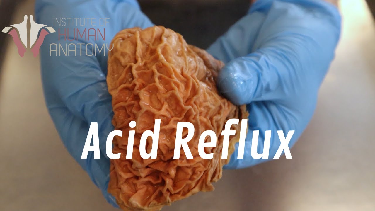 What Is Acid Reflux?