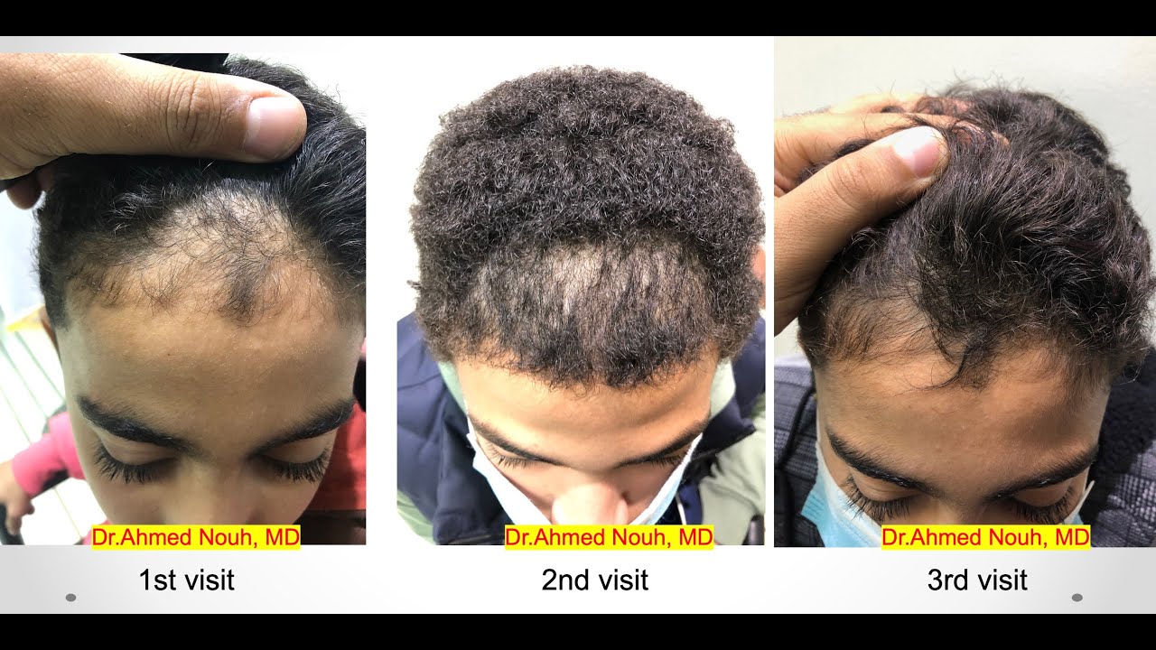 Frontal hair line disorders part 2