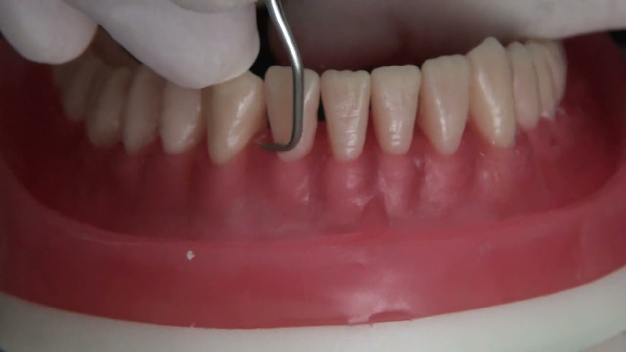 RASPAGEM PERIODONTAL DO 5º SEXTANTE