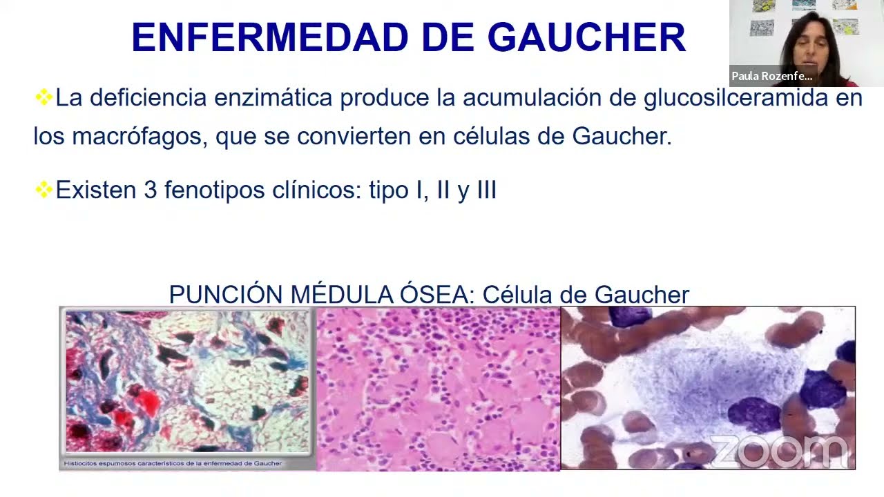 Webinar AAOMM - Fisiopatologia ósea en la enfermedad de Gaucher