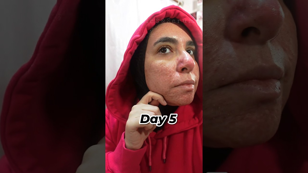 Day 5✨️CO2 laser recovery 