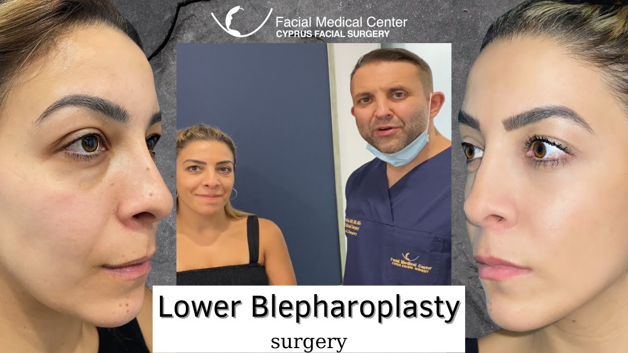 lower blepharoplasty - Eyelid Surgery |Cyprus Facial Surgery