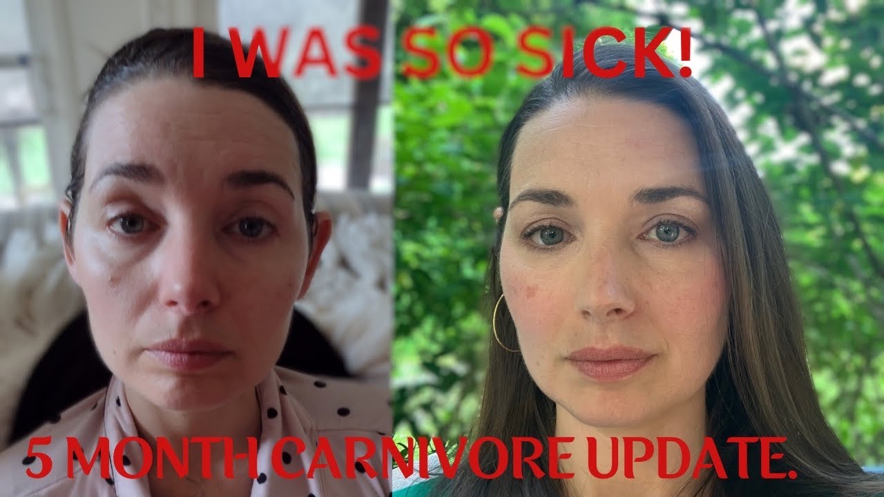 ME/CFS after 5 Months on Carnivore.
