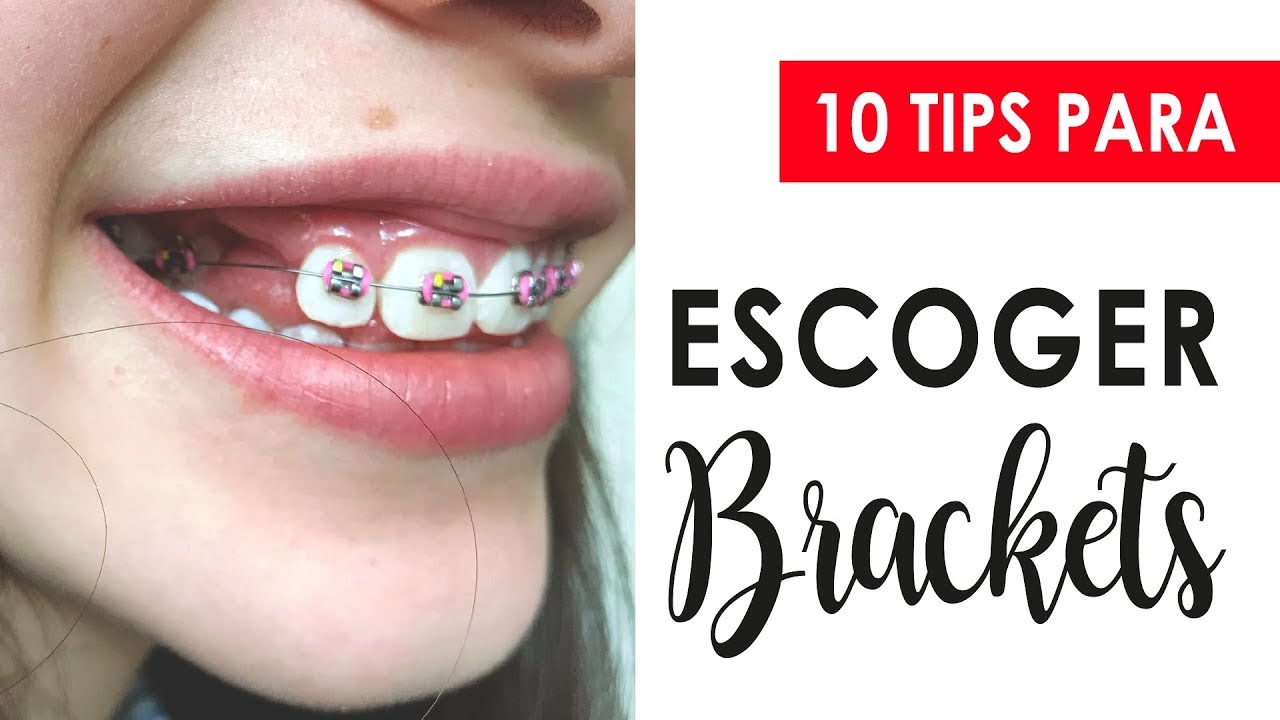 ESCOGE BRACKETS FÁCIL CON ESTOS 10 TIPS