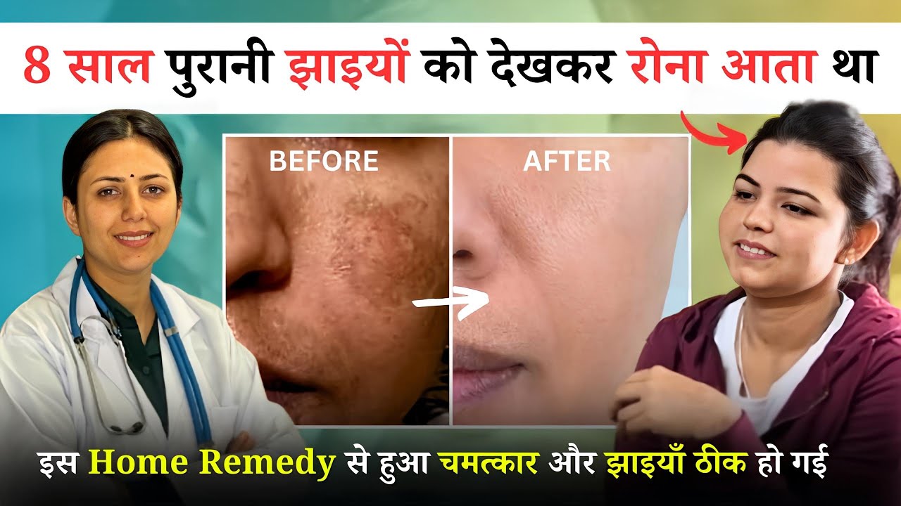 8 साल पुरानी Pigmentation को किया 100% ठीक | Melasma Treatment | Dr. Upasana Vohra Patient Review
