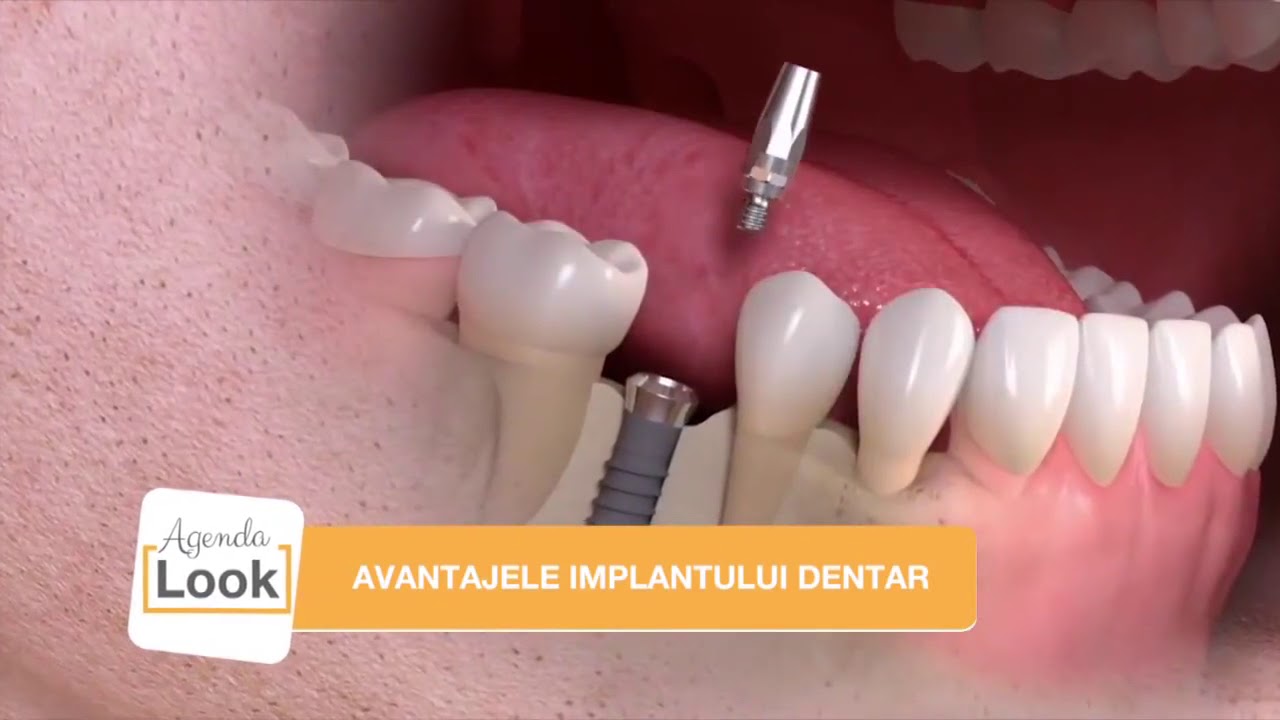 Avantajele implantului dentar