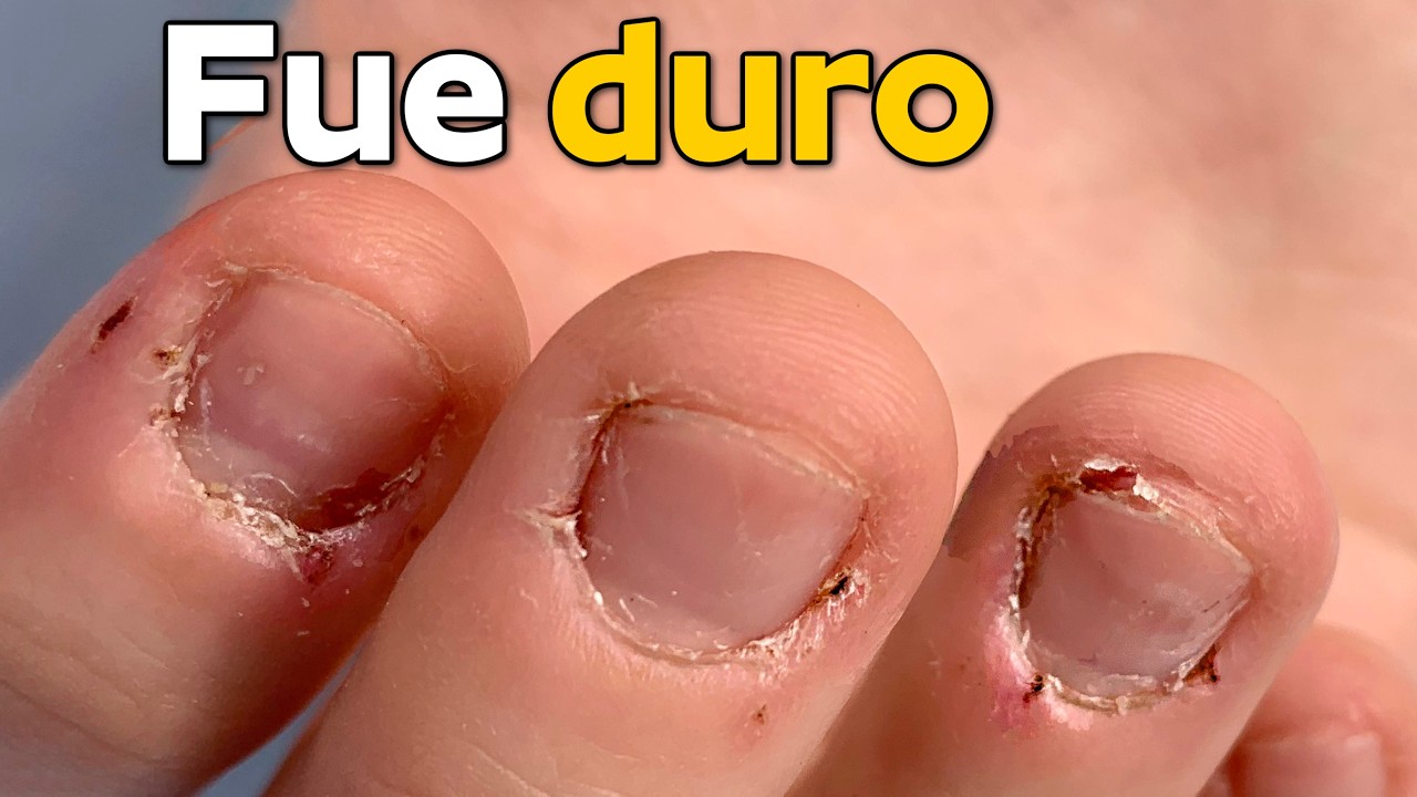 Transformación de uñas mordidas y cutículas extremadamente secas con acrílico