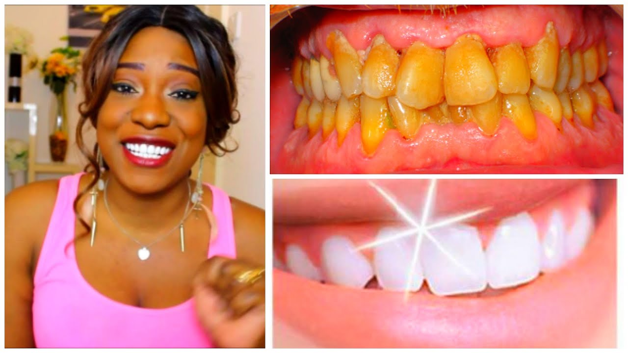 ADIEU TARTRE! BONJOUR DENTS PROPRES ✿5 ASTUCES✿