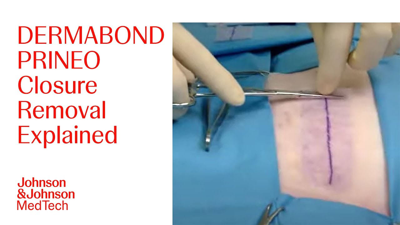 Как безопасно удалить систему закрытия кожи DERMABOND PRINEO | J&J MedTech
