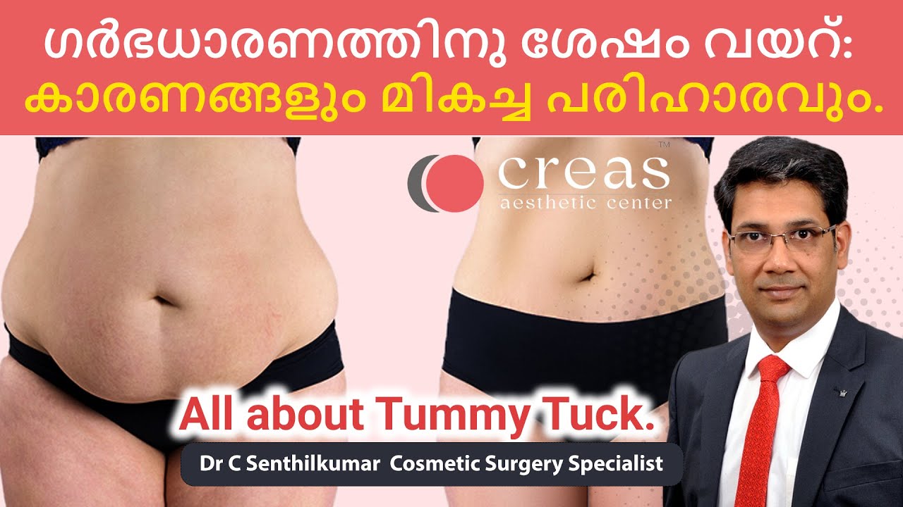 Tummy Tuck in Malayalam | How to reduce your tummy after ur delivery ? | Causes,Steps and Costs ?