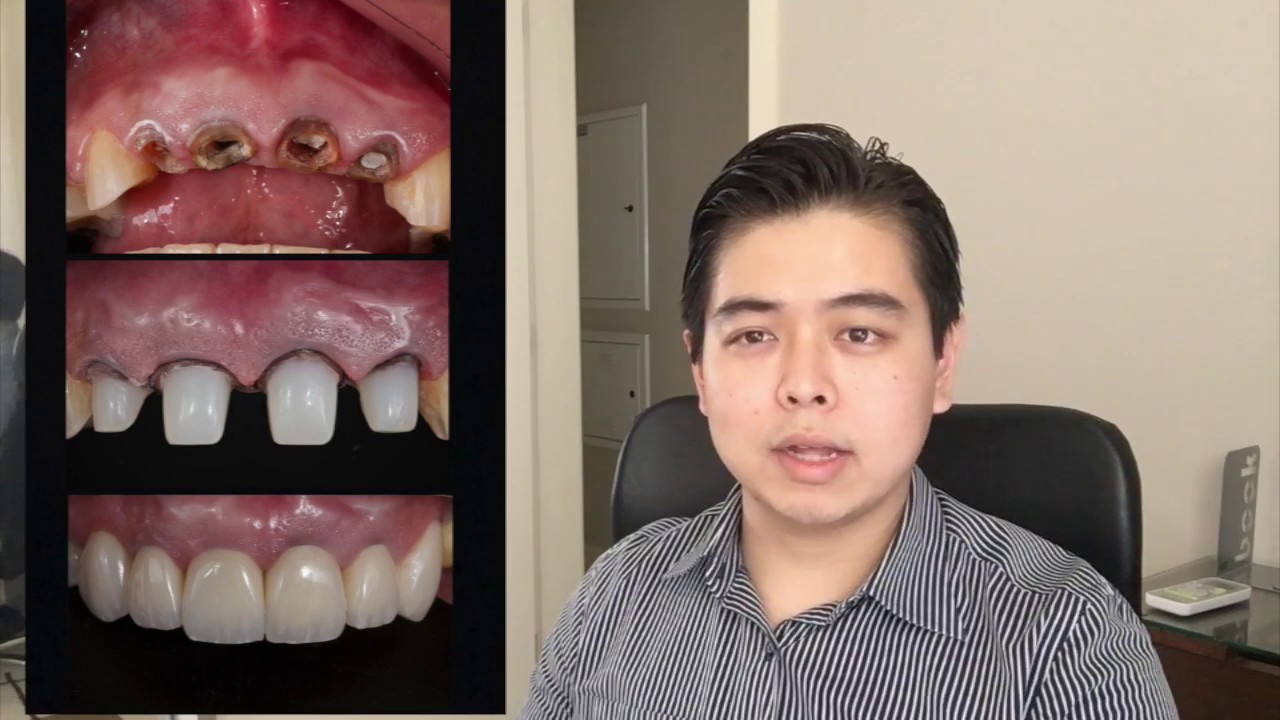 O que é Implantodontia?