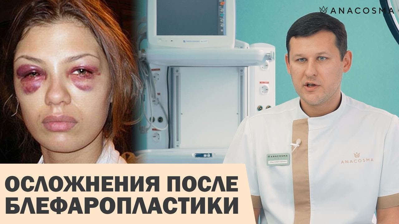 ОСЛОЖНЕНИЯ ПОСЛЕ БЛЕФАРОПЛАСТИКИ 😱🤯 КАК ИЗБЕЖАТЬ ❓