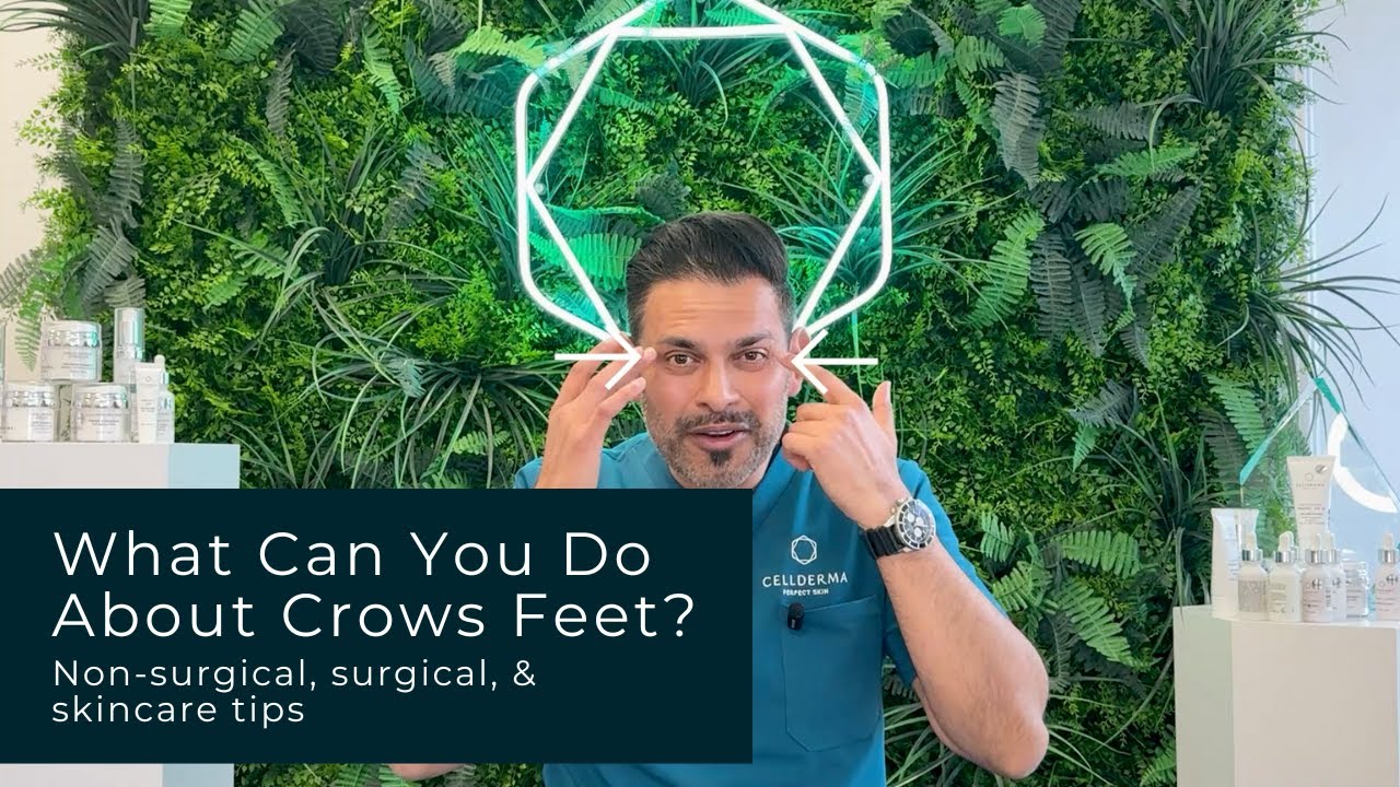 What Can You Do About Crows Feet? | Non-surgical & Surgical Options & Skincare
