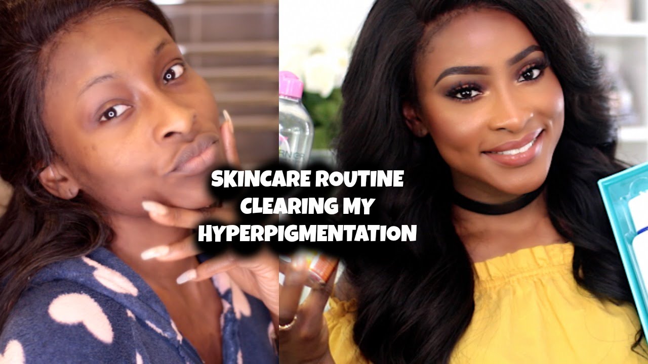 SKINCARE ROUTINE | HOW I CLEARED UP MY HYPERPIGMENTATION
