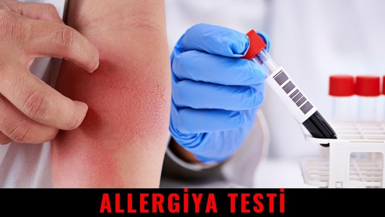 Allergiyamızın olduğunu Necə Öyrənək? | İmmunoqbulin E