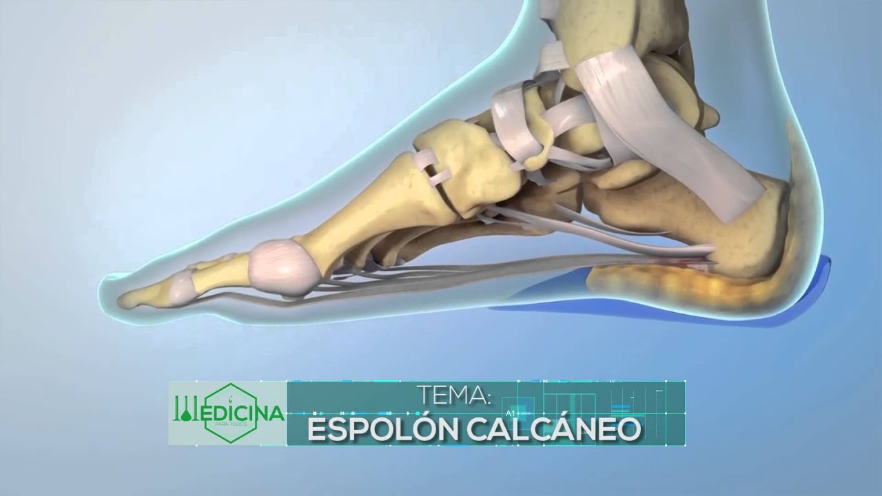 Medicina para todos: Espolón Calcáneo