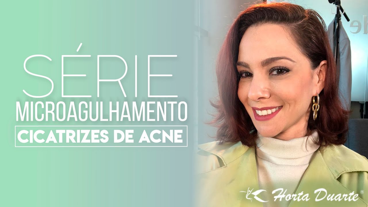 Série microagulhamento - cicatrizes de acne