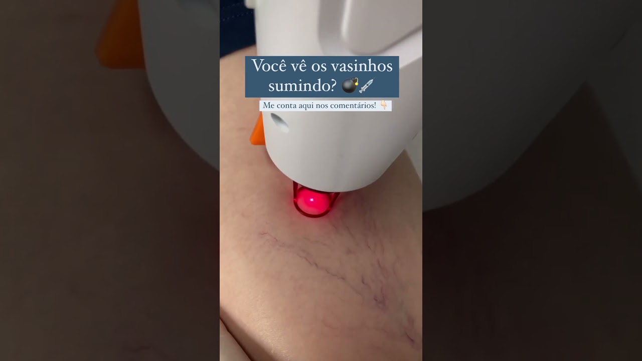 Tratamento de #varizes e #vasinhos com LASER TRANSD&Eacute;RMICO associado a ESPUMA! 🩸💉