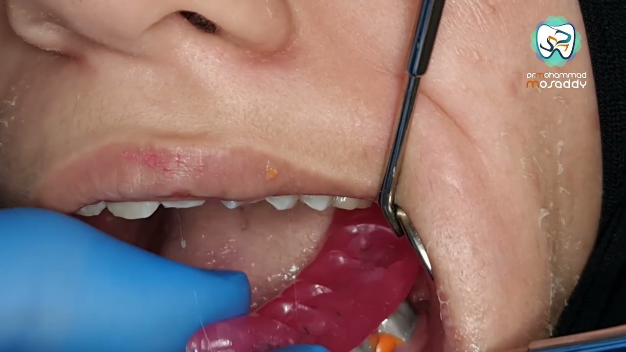 طريقة تجربة المعدن لجسر خزف و طريقة الالصاق pfm   try in