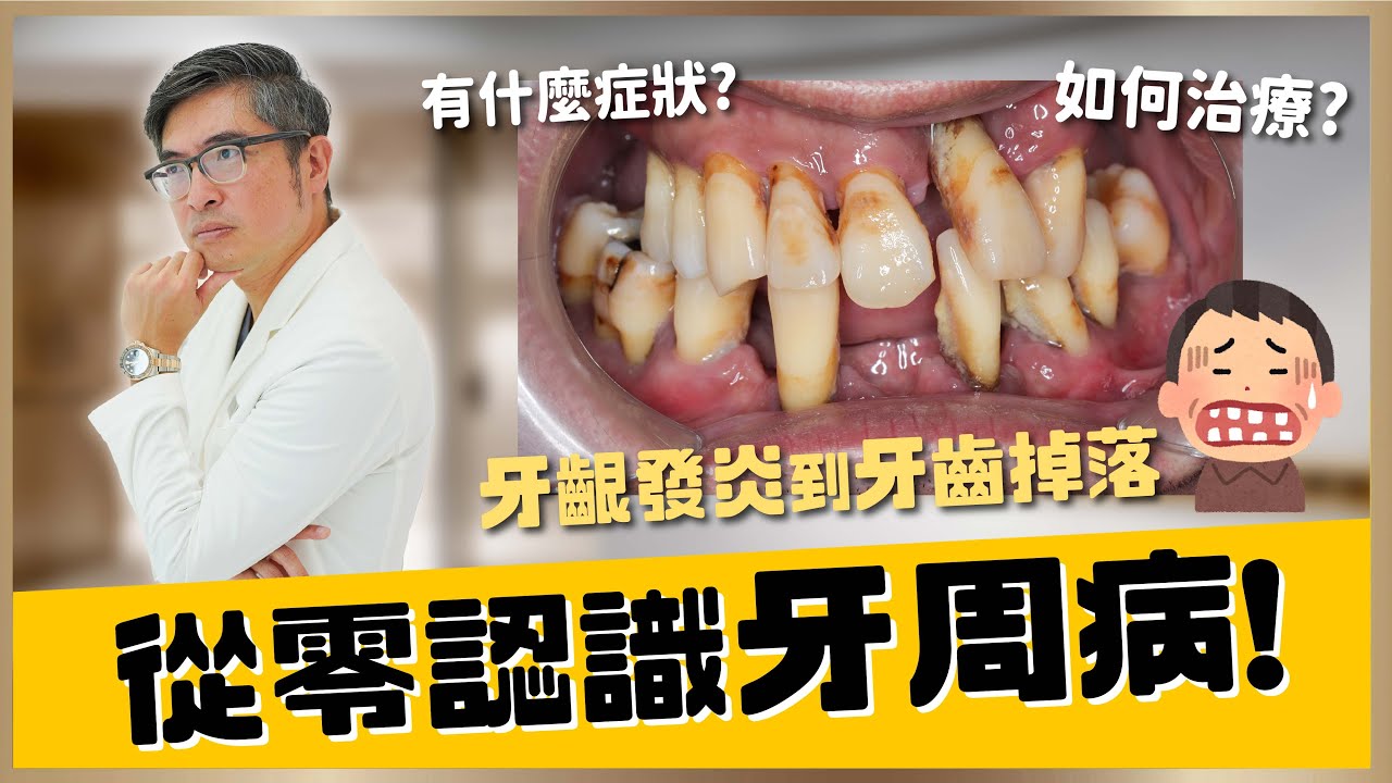 【水雷射 #2】牙周病完整大解析，從零認識牙周病！牙齦發炎、腫痛、牙縫變大到牙齒掉落，從4大階段自我檢視牙周病的程度與治療方法｜【祐民牙醫－隱適美旗艦店】鑽石級楊大為醫師 #牙周病 #洗牙 #水雷射