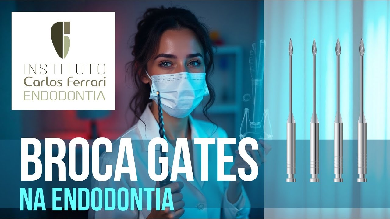 Broca gates na endodontia