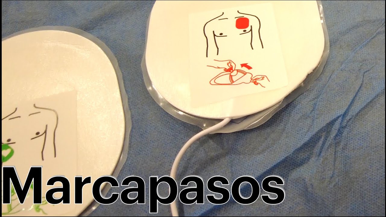 Marcapasos y Monitor desfibrilador
