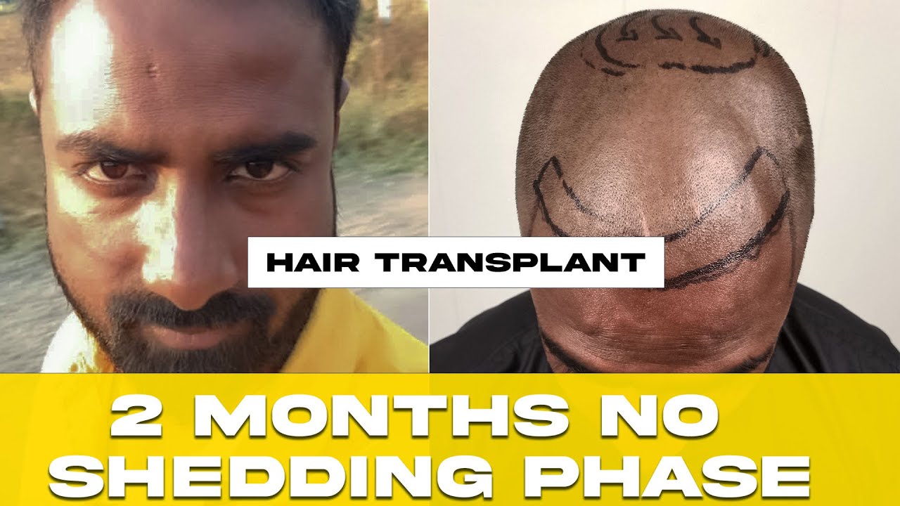 MY 2 MONTHS TRANSPLANT RESULT| No Shedding phase | 60 Days After Hair Transplant |