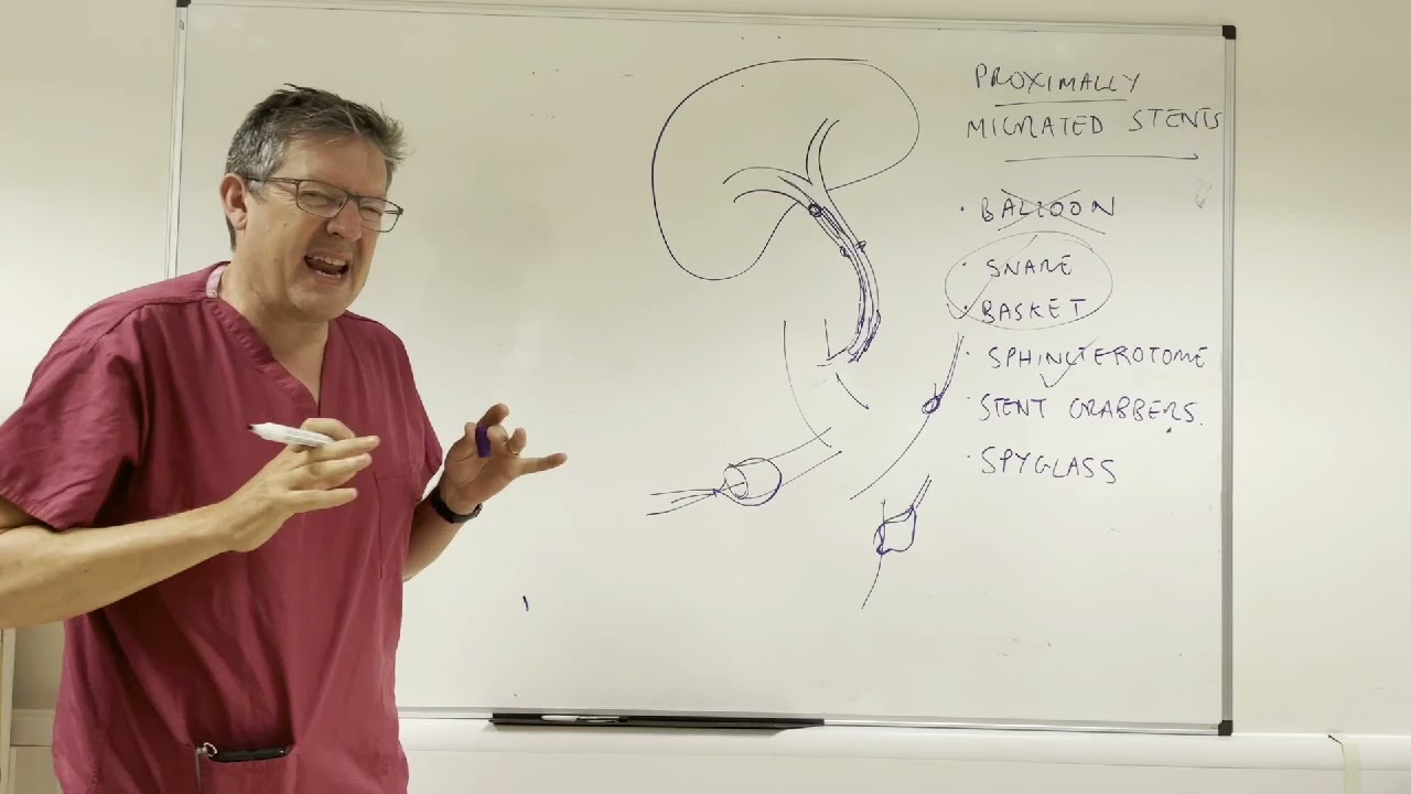 GastroLearning Express: How to Remove Migrated Biliary Stents