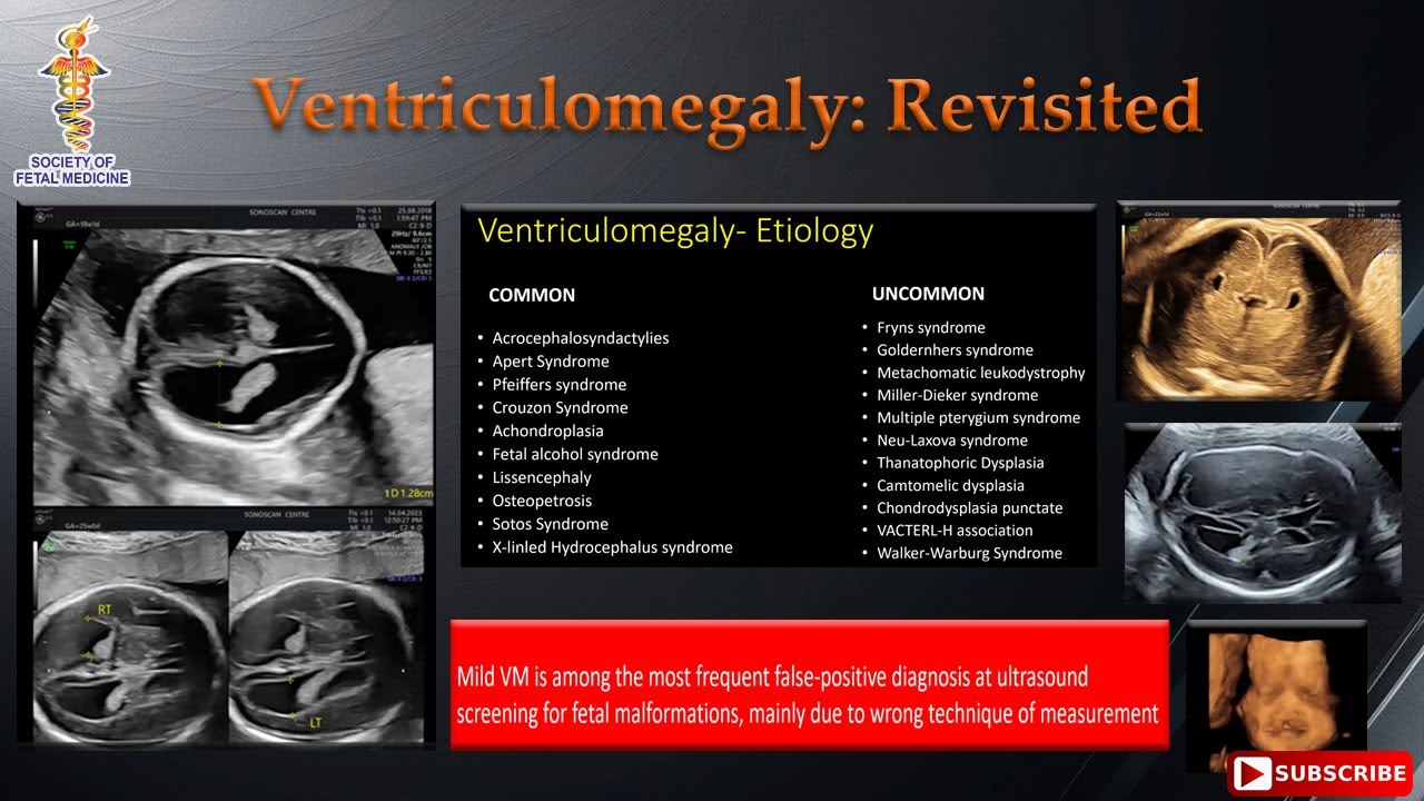 Ventriculomegaly: Revisited