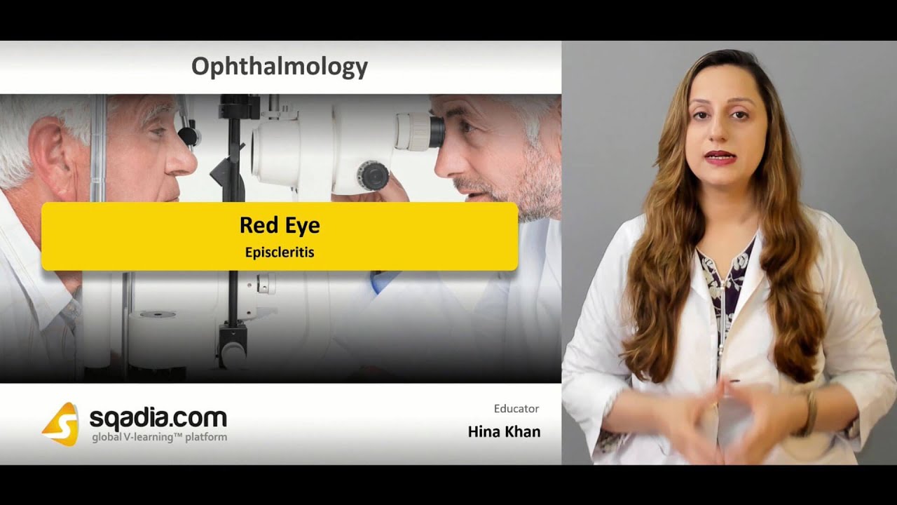 Red Eye | Episcleritis | Ophthalmology Video Lectures | Medical Education | V-Learning