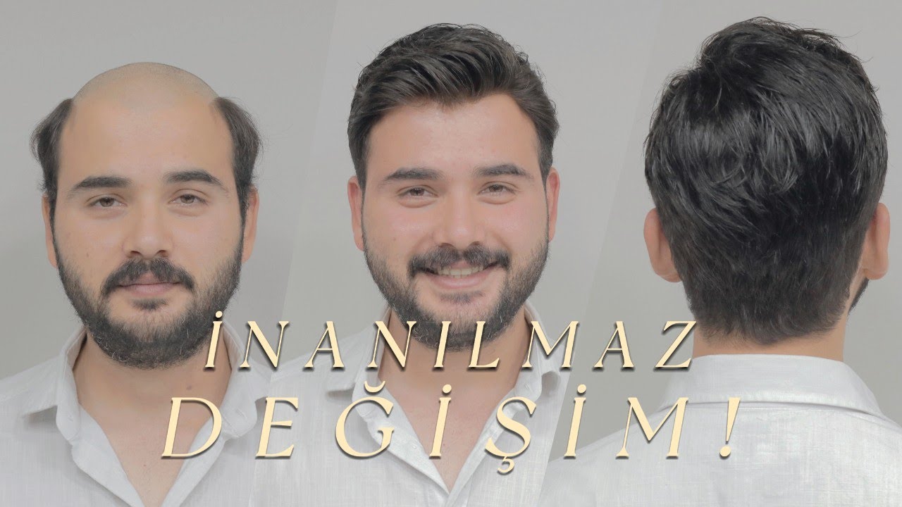 PROTEZ SAÇ İLE İNANILMAZ DEĞİŞİM! - Hair Replacement