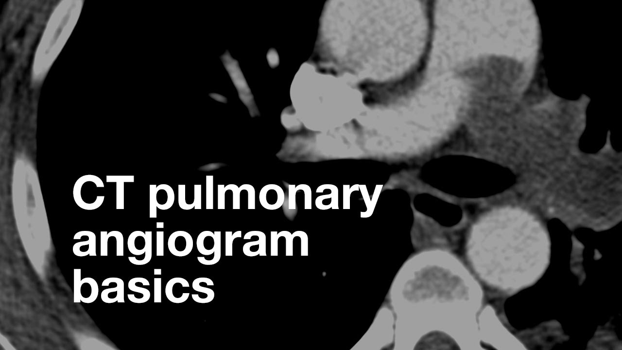 Pulmonary CT Angiogram Basics