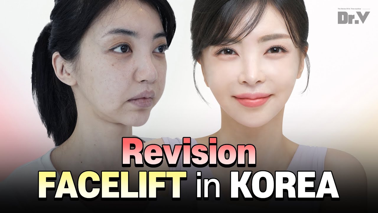 REVISION facelift experience at VLIF