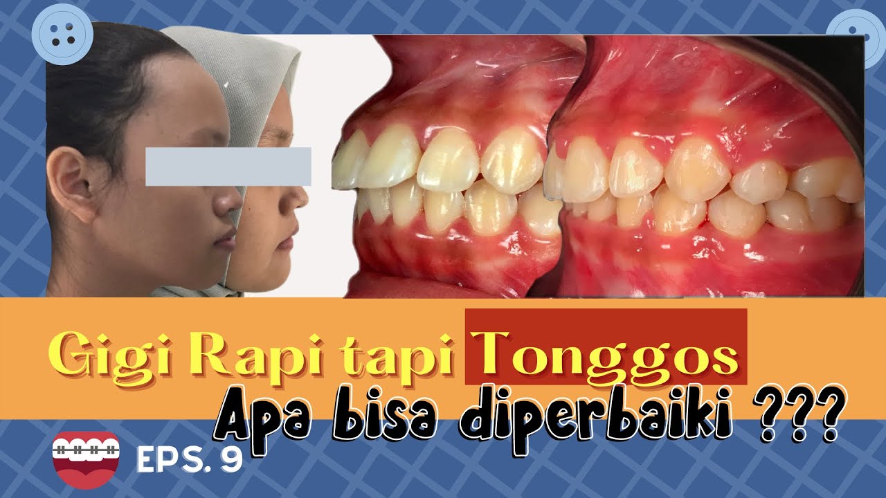 Gigi rapi tapi tonggos. Apa bisa diperbaiki? Eps.9