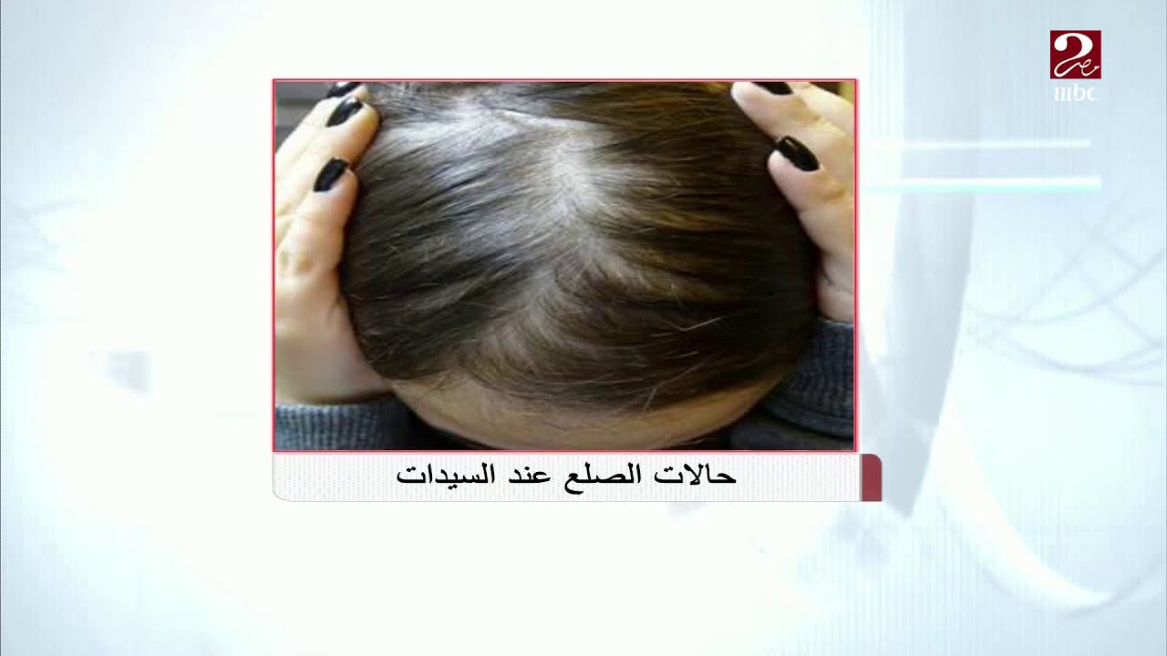 دكتور عاصم فرج يكشف العلاج الفعال لصلع السيدات