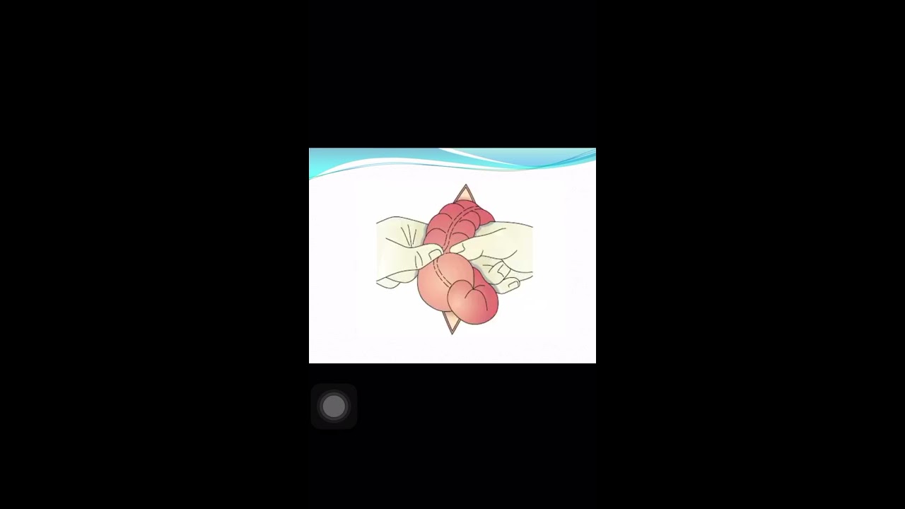 Clinical features of intestinal obstruction / د.مهند الشريفي