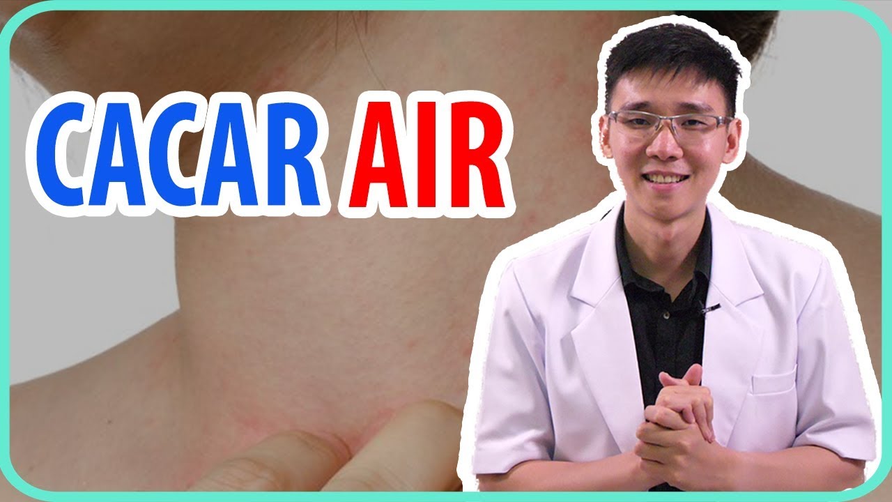 Gejela dan Penyebab Cacar Air | Penjelasan Dokter