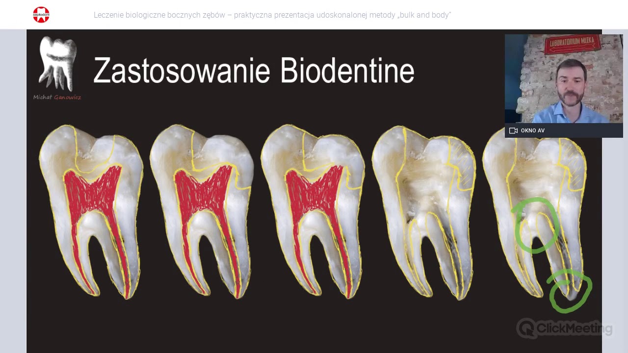 Leczenie biologiczne bocznych zębów – praktyczna prezentacja udoskonalonej metody „bulk and body”