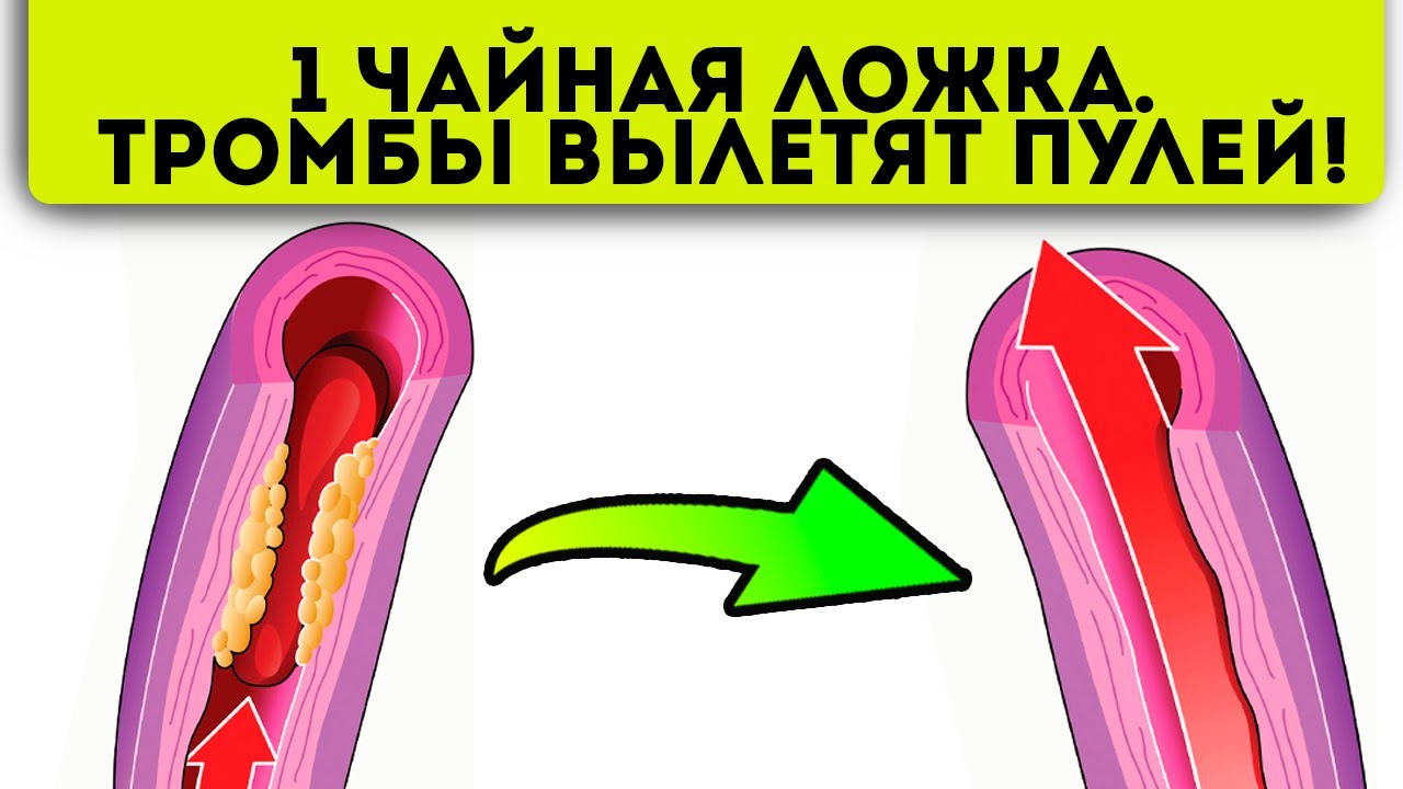 Этот коктейль моментально чистит сосуды от тромбов! Убойная смесь от инфаркта, инсульта…