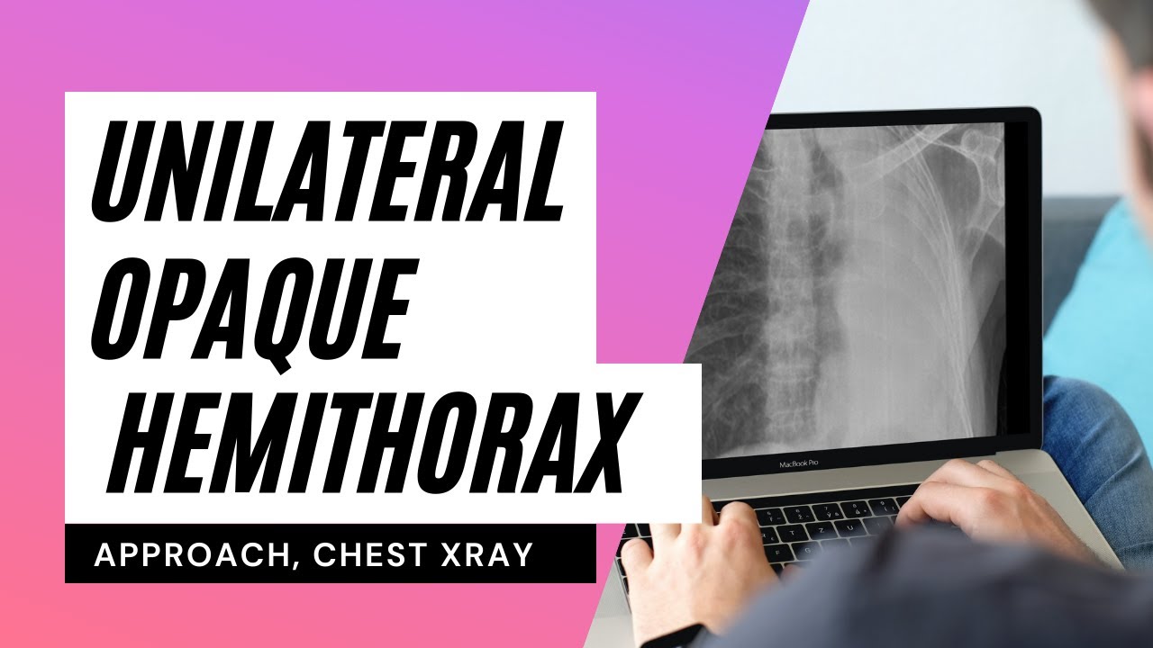 Approach to Unilateral White-out Lung