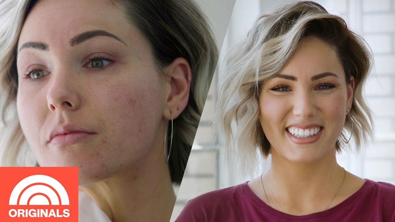 Adult Acne: How 5 Women Control Their Breakouts | Today