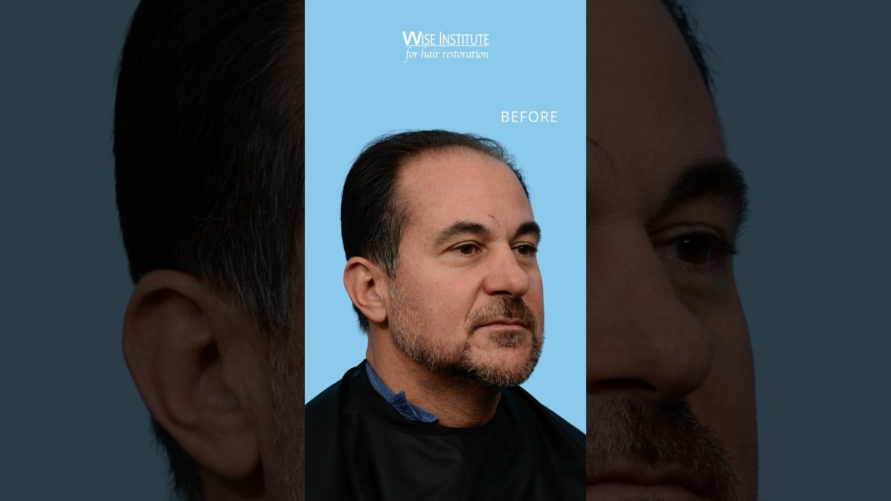 Rebuild and strengthen your receding hairline with an FUE Hair Transplant procedure