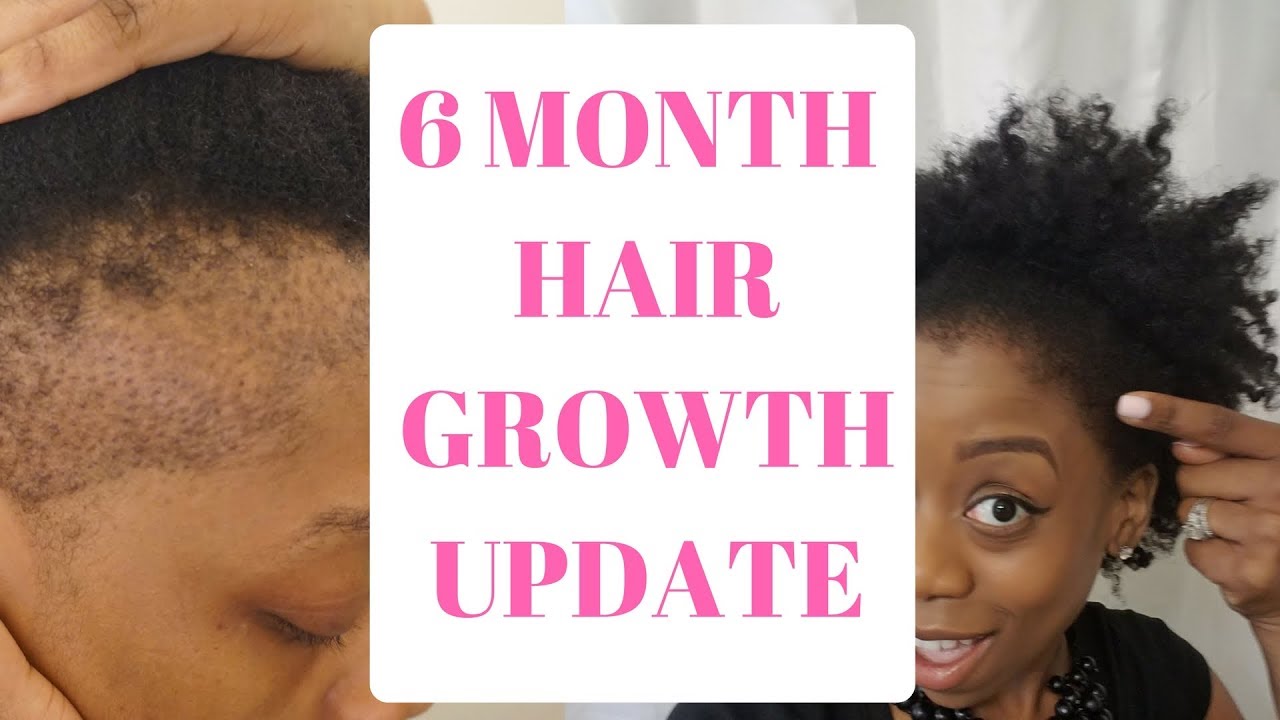 NATURAL HAIR| HAIR GROWTH|6 MONTH| HAIR TRANSPLANT UPDATE