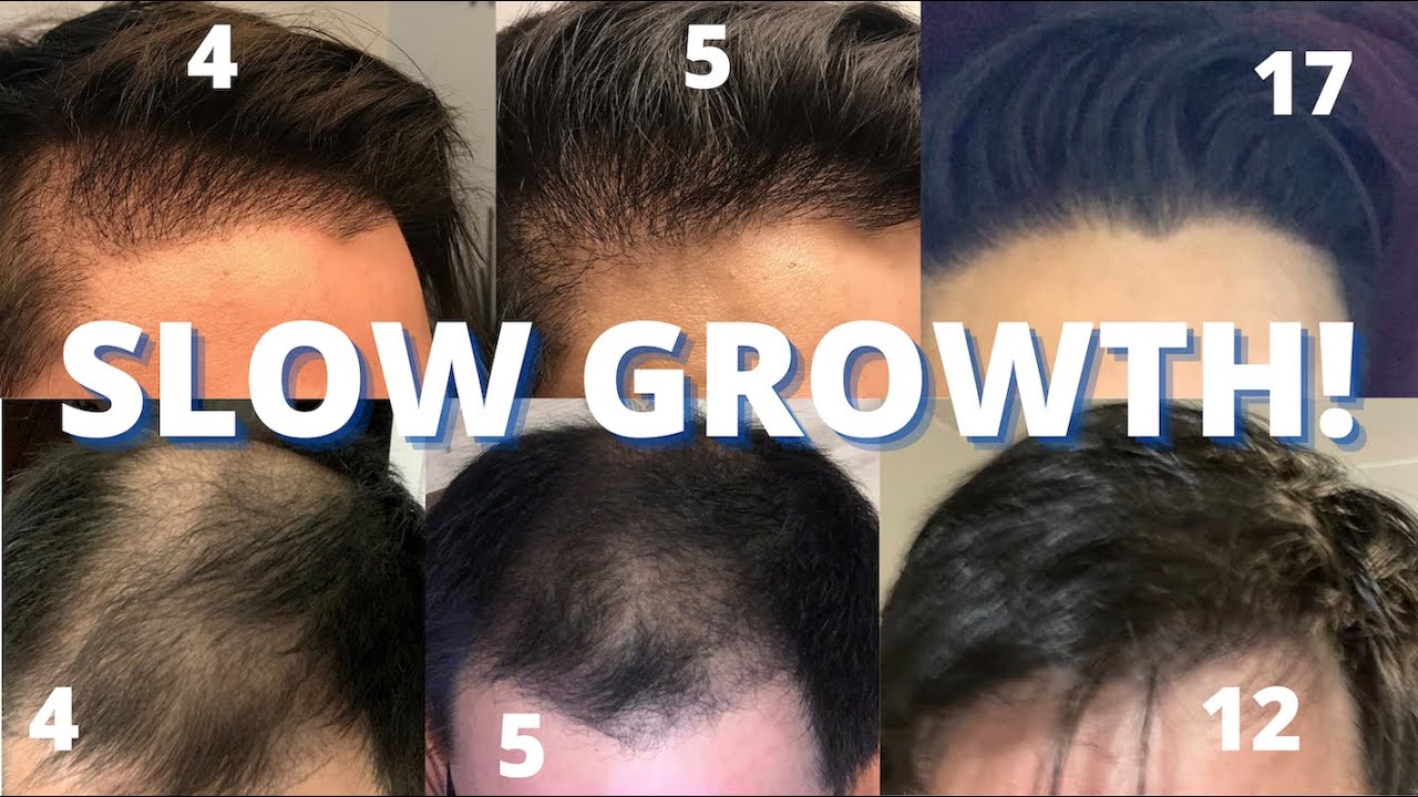Hair Transplant Slow Growers Watch THIS!