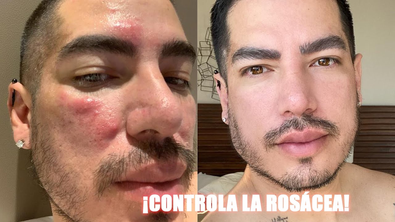 TODO SOBRE ROSÁCEA | MI EXPERIENCIA Y RECOMENDACIONES | Pepe Gutiérrez